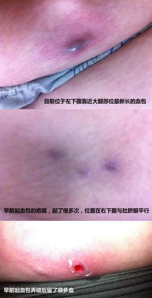 帮我看看我肚子上长得这个像血包一样的东西是什么东西?