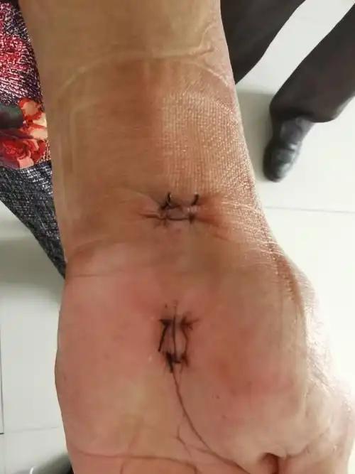 小切口解决大麻烦～驻里则社区卫生服务中心城市医师下基层记