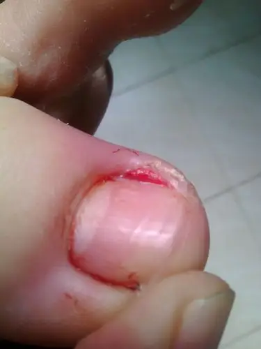 大脚趾流脓,不知道是不是自己剪过度了