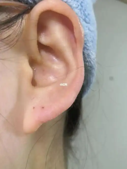 耳洞打完两个月这样正常吗