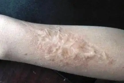 什么是萎缩性疤痕