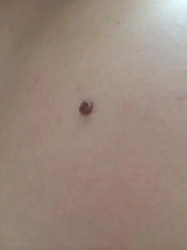 皮肤上长这个黑色的肉痣是什么,对身体有害吗?