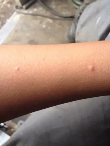 这几天浑身没劲.手臂上今天出现两个痘痘不知道是不是患了艾滋病