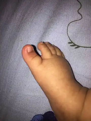 三月宝宝大拇指脚趾头突然这样了 红肿了 是甲沟炎吗 不疼