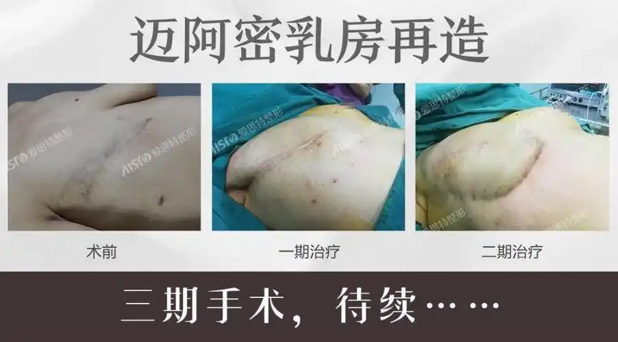 武汉爱思特张敏院长迈阿密乳房再造是真的吗?让胸部从无到有,重新长大