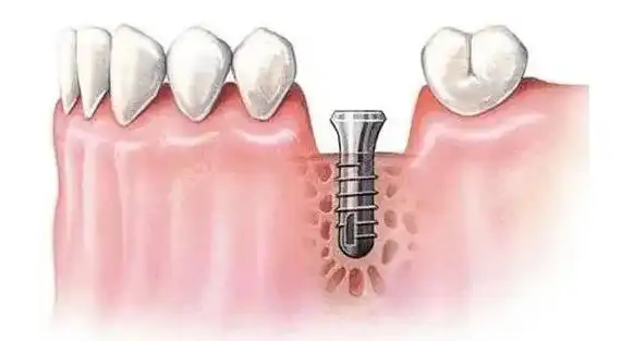 牙槽骨吸收了还能种植牙吗可通过植骨粉骨膜修复来种牙哦