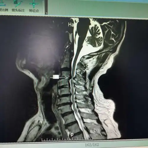 病例分享 颈椎管狭窄一定需要后路单开门吗?