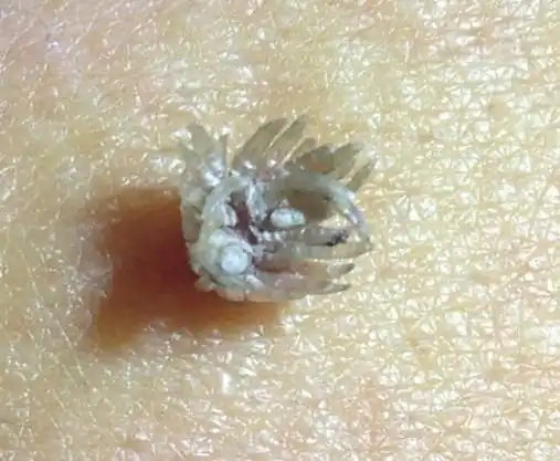 长瘊子用头发丝系上能治疗吗身上为什么会长瘊子