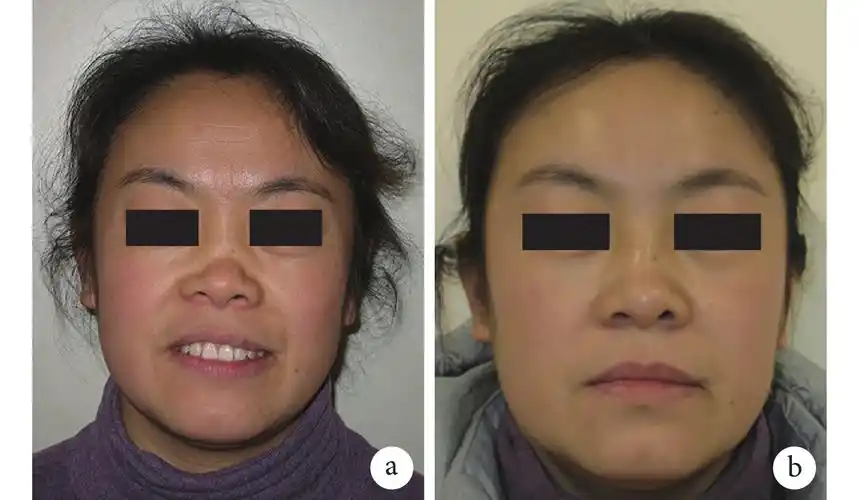 应用硅胶假体矫正复发性多软骨炎所致鞍鼻畸形一例