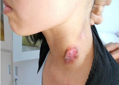 颈部淋巴结肿大