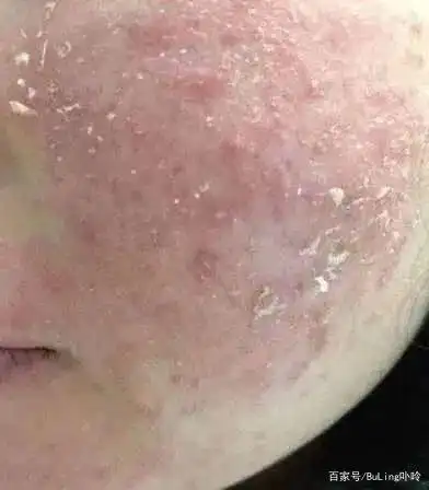 唇部干裂?皮肤起屑?拒绝成为"干妹妹"的教程来啦