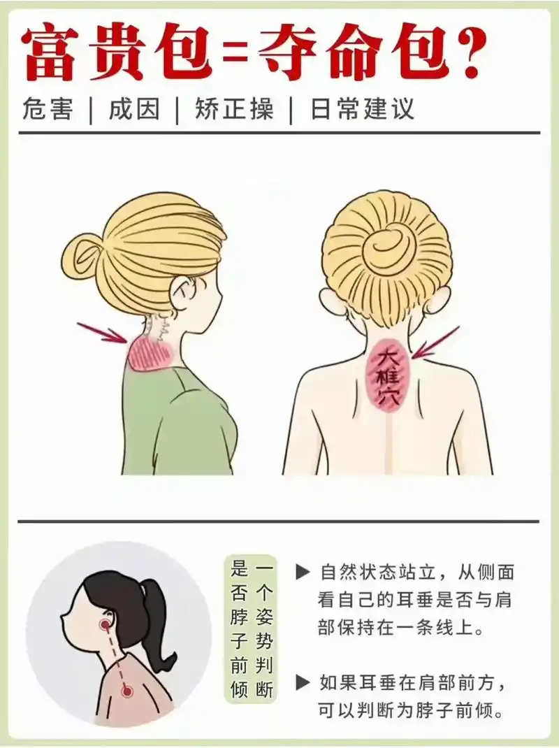 富贵包形成原因: 1,代偿(上下功能不好,颈椎胸椎交界处过度 - 抖音