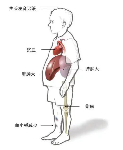临床常表现为脾肿大,肝肿大,骨痛,贫血,血小板减少,神经系统症状等,也