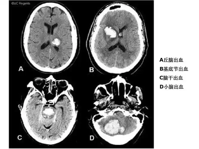 医学影像学 头颅 诊断 ct 头颅ct解剖及诊断 a丘脑出血 b基底节出血 c
