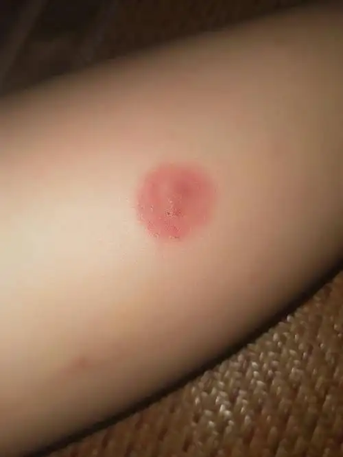 我腿上不知道被什么咬了一个大红点,又痒又痛