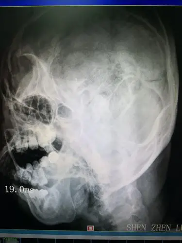 左侧颞颌关节张口位片左侧颞颌关节闭口位片返回搜狐,查看更多