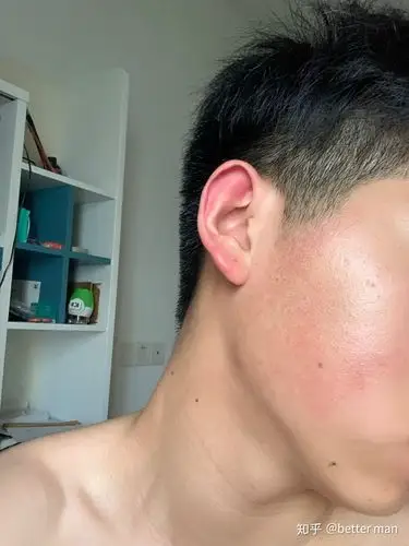 毛周角化,面部红斑黑变病