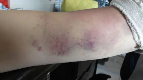 阿姨学中医给我拍胳膊内侧,结果出现大片瘀血青紫,很严重,说我身体里