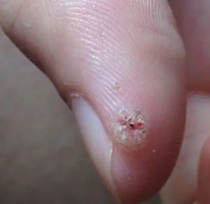 大拇指指尖长了个像疣的东西