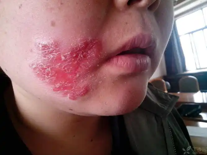 男性,30岁面部红斑7年,缓慢向外扩展.