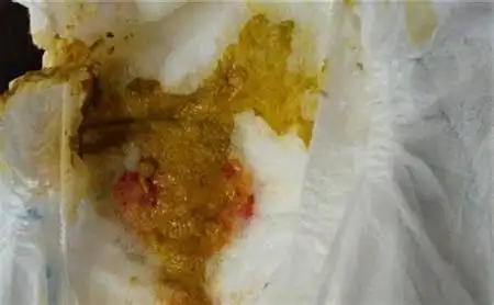 肠炎大便图片结肠炎大便不成形2022已更新今日图集