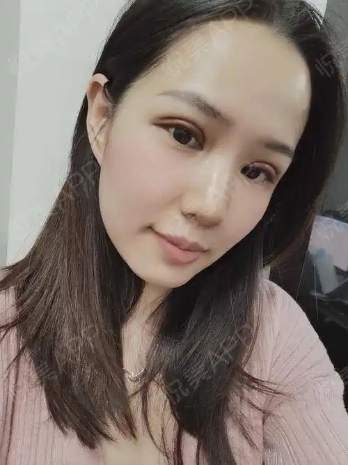 眼综合整形术后2天_全切双眼皮术后2天_眼型矫正术后2天_眼综合术后2