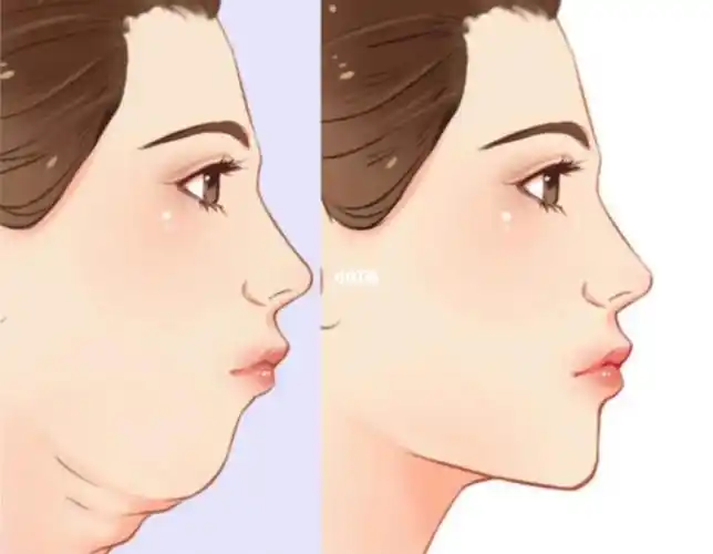 面部肌肉练习的角度-如何改善双下巴