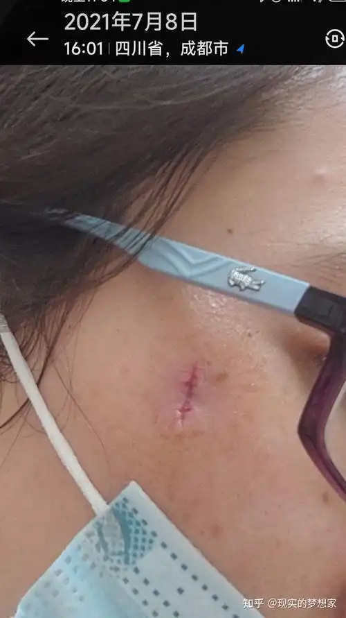 表皮囊肿战斗史,还长脸上的那种.96术后第二天 - 知乎
