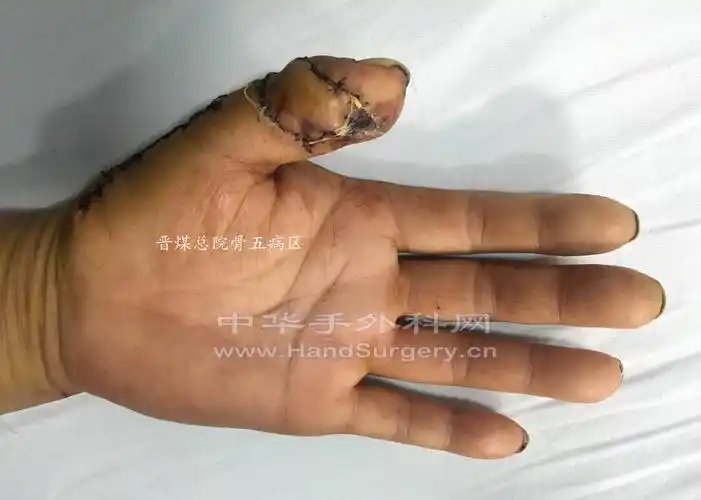 拇指背动脉皮瓣