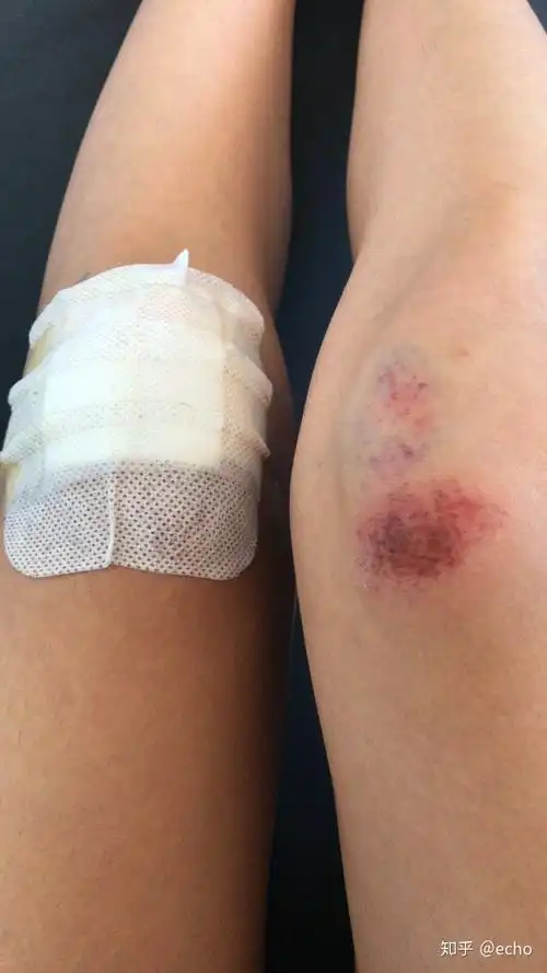 腿摔伤成这样自己在家该怎么弄才会好的得快? - 知乎
