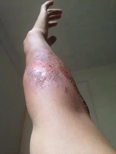 胳膊擦伤,昨天抹了碘伏红霉素,今天都固了不敢动动下就又开口子了,我