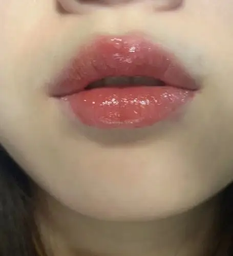 上嘴唇长得这是什么泡呀【有图】