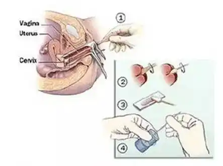不能忽视的五项妇科检查