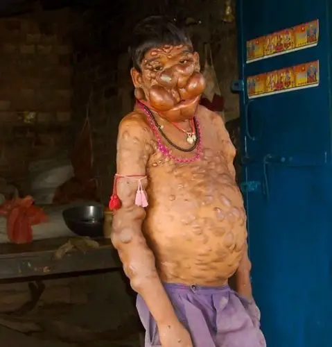 印"幽灵男孩"患罕见疾病 面部与身体布满肿瘤_手机搜狐网