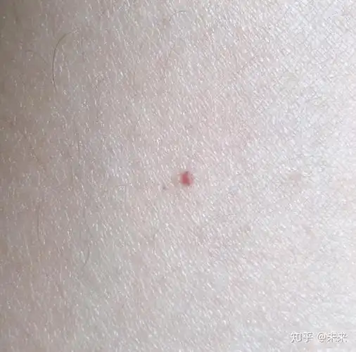 皮肤上凸起的小红点该怎么治疗