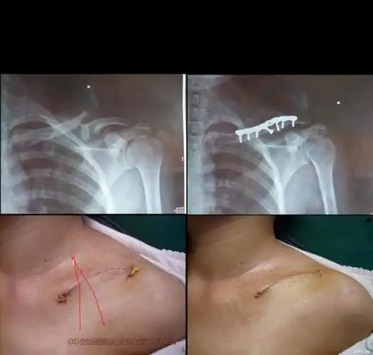发一例锁骨骨折