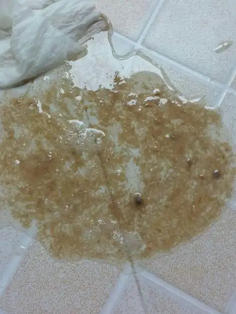 这是刚才呕吐物照片.