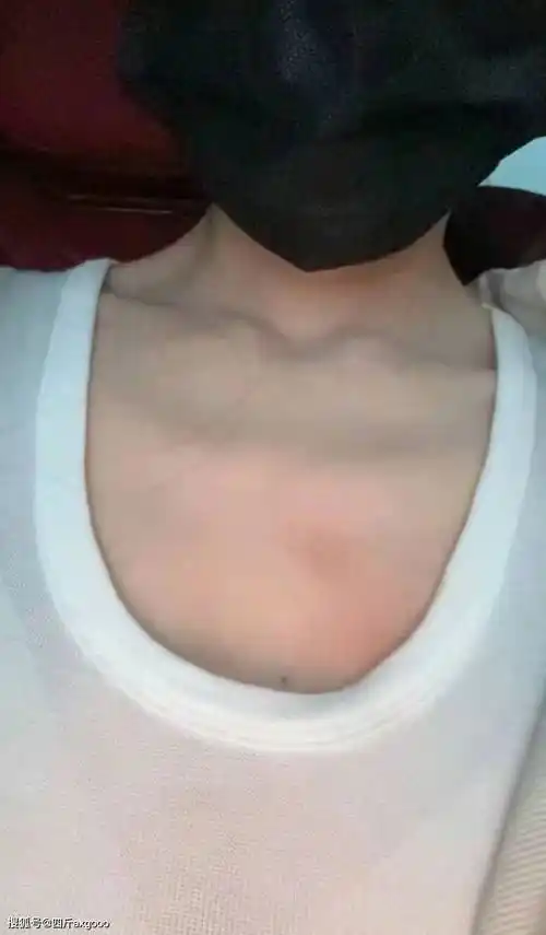 杜淳老婆王灿意外被烫伤,锁骨胳膊大腿均受伤,庆幸和孩子换位置