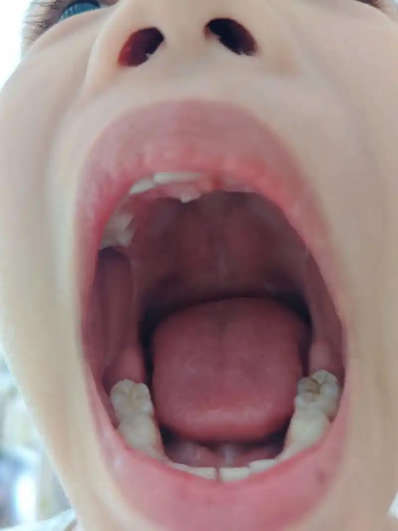 讲话的瞬间发现他的门牙晃动,他一张嘴,弟弟的多生牙竟然长出来了!