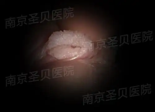 菜花状赘生物图片
