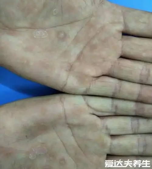 梅毒疹图片及症状梅毒梅毒疹图片大全