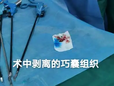 多发性卵巢巧克力囊肿双侧输卵管粘连腹腔镜下手术圆满完成