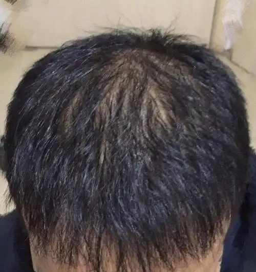 头顶发量还有点少,还要坚持用药啊