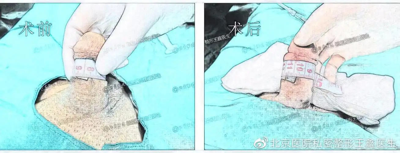玻尿酸微创注射进行阴茎增大2,手术延长阴茎:由于阴茎体不是完全暴露