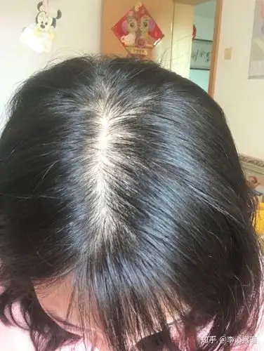 医生问我觉得脱发比较严重的地方是哪里,我说是头顶,就从头顶拔了五根