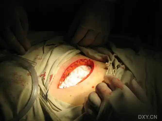 【资料】小切口治疗巨大肾囊肿(附ct,手术切口,术中情况)