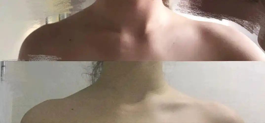 半个月我的锁骨平了