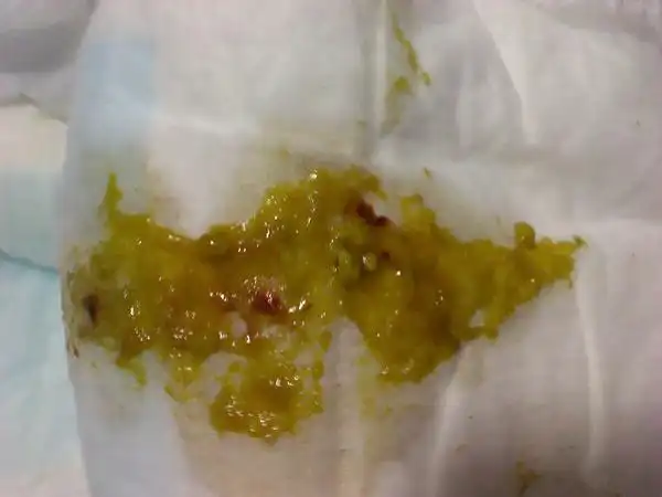 宝宝大便中带红的情况