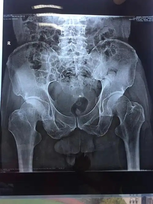 置换手术前拍的dr照片,右侧股骨颈断裂,断端部分嵌插.