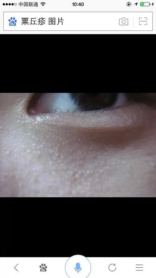 helphelp这是粟丘疹吗有没有办法治愈